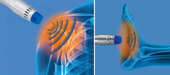 terapia de ondas de choque