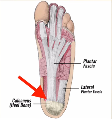 fascia plantar ondas de choque