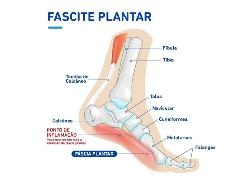 fascite plantar com ondas de choque